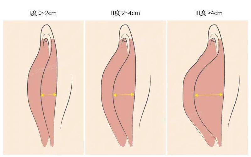 外阴外翻是什么原因引起的