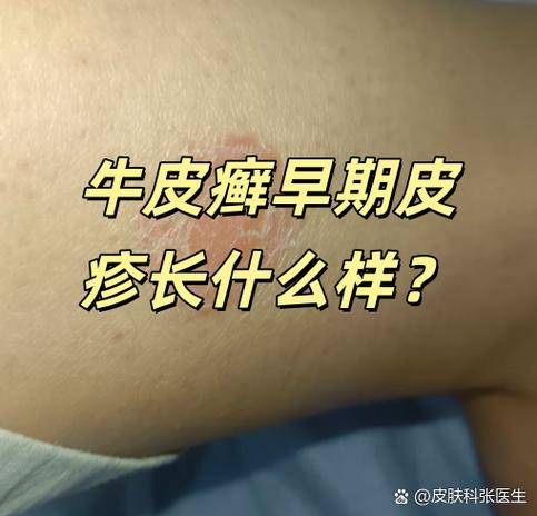 牛皮癣早期图片截图
