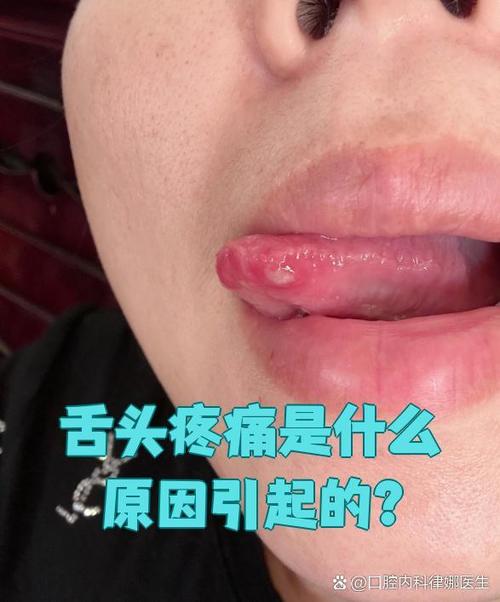 舌头中间疼