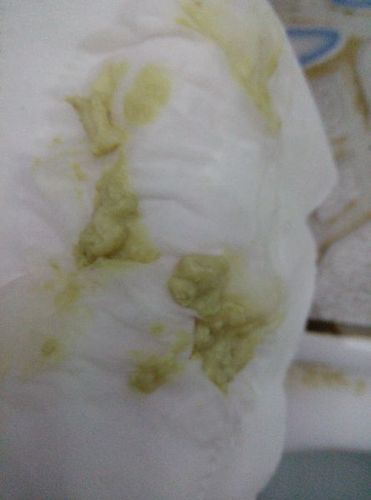 排出一大坨黄绿色的豆腐渣状截图