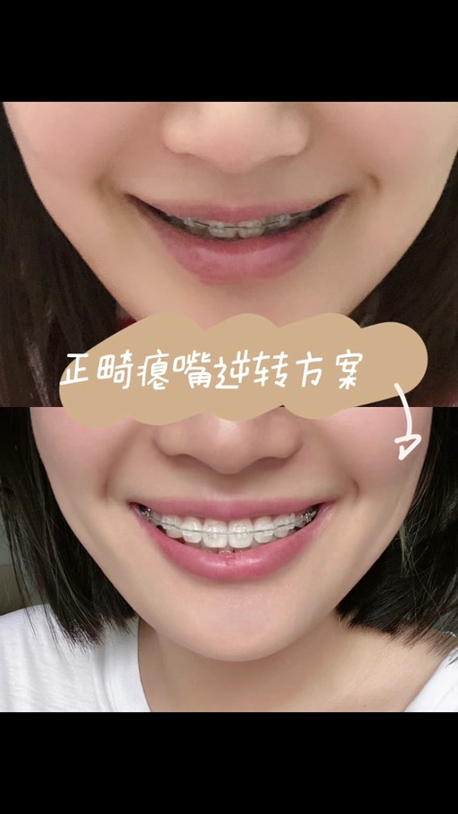 正畸内收3mm对比