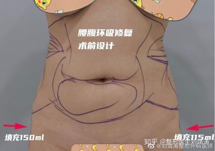 腰腹环吸大概多少钱