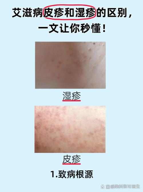 红疹和湿疹图片对照