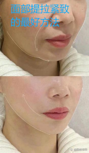 提拉贴会越用越松弛吗缩略图