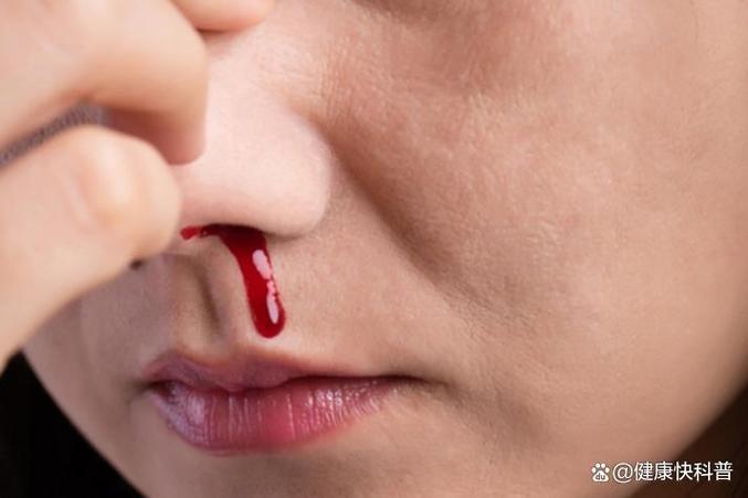 病毒感染会流鼻血吗截图