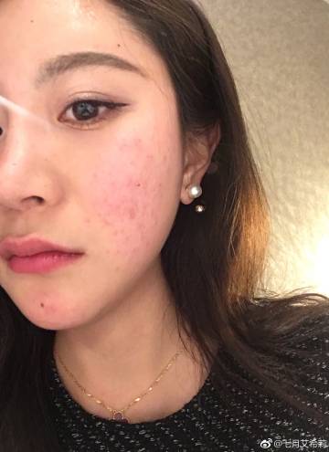 一言不合就过敏