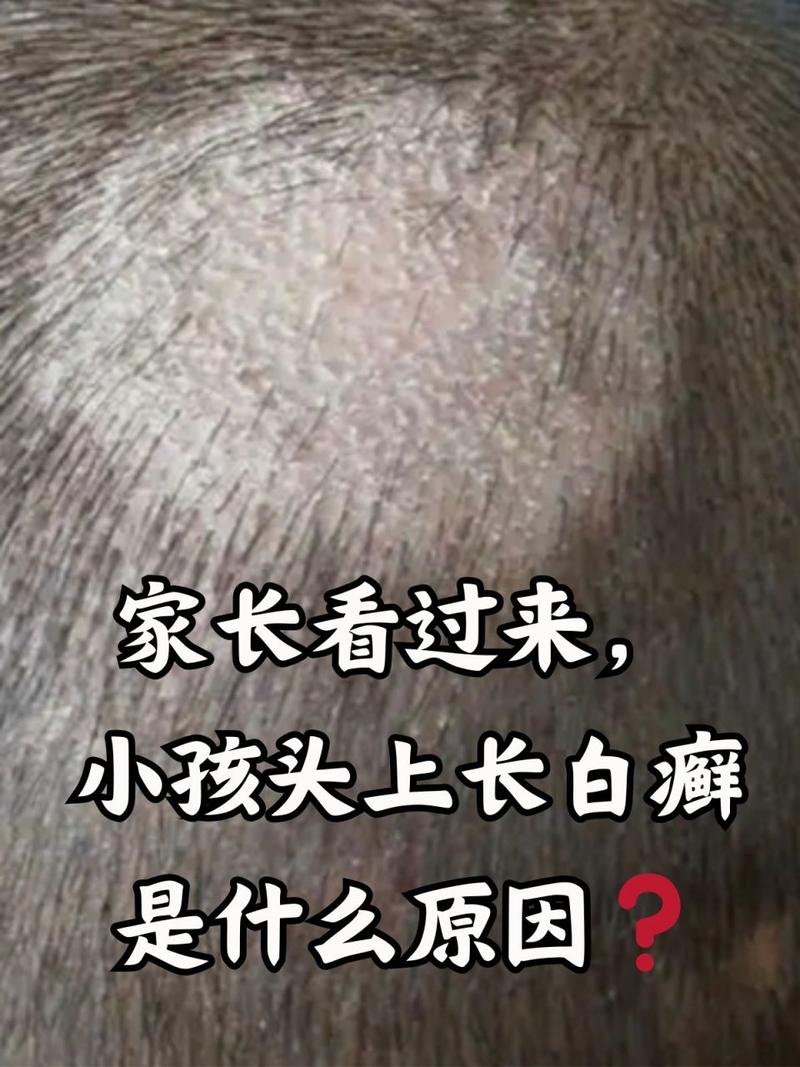 宝宝头皮上有白斑图片截图
