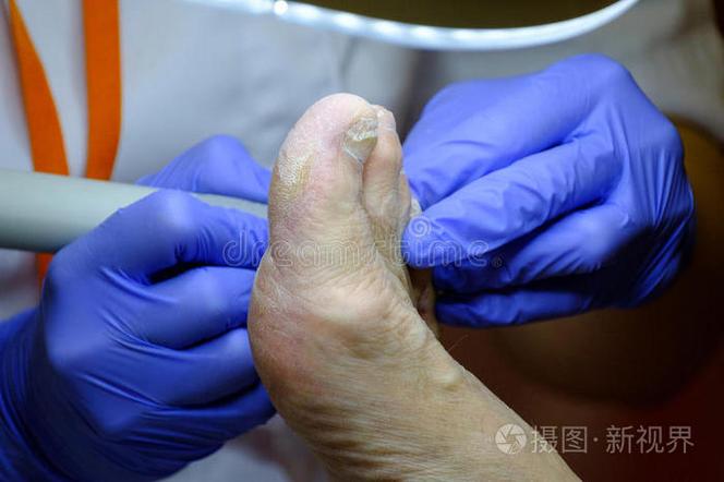 大拇指甲有黑色竖线是什么原因