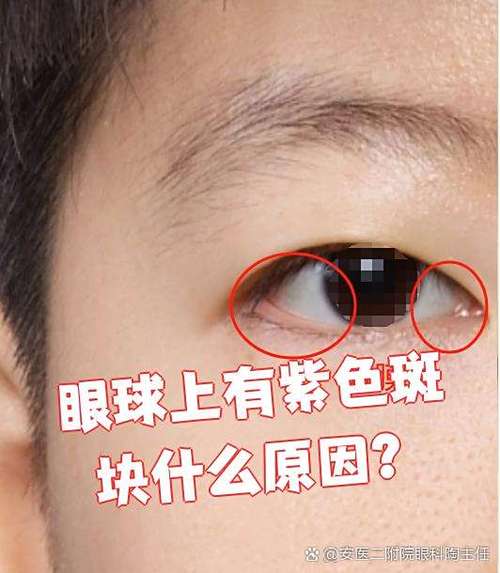 眼睛里有紫斑是怎么回事图标