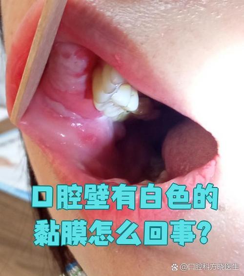 口腔黏膜炎治疗方法截图