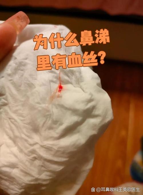 为什么易流鼻血