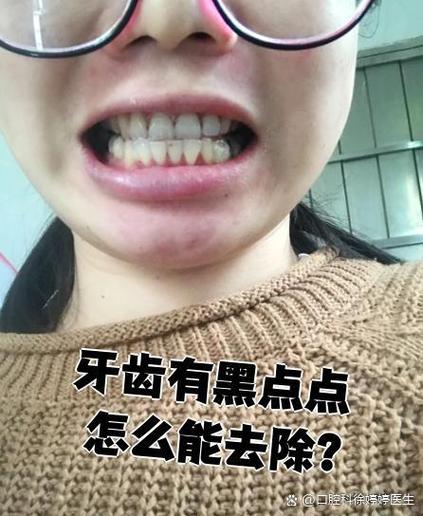 牙齿有黑点怎么去除截图