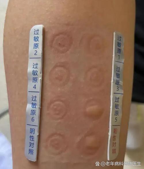 医生为什么不建议查过敏源