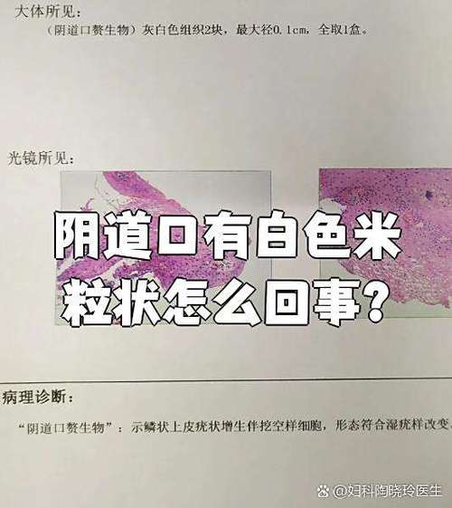 阴外侧有白色的颗粒是什么原因