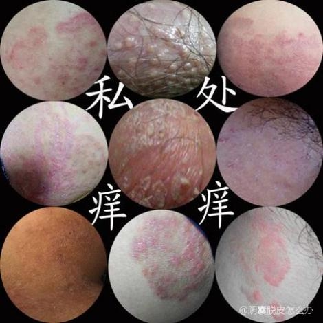 男人下面蛋皮痒脱皮