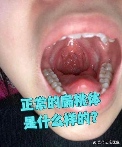 正常扁桃体图片截图