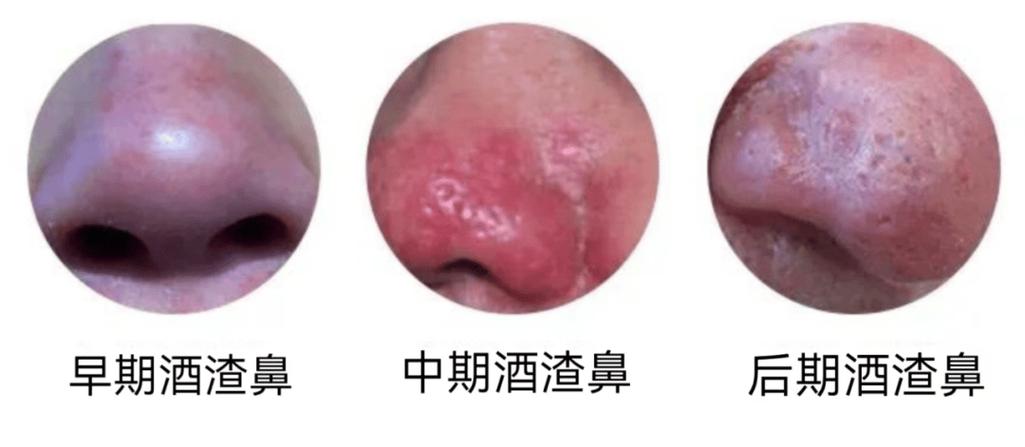 红鼻头的治疗最简单方法