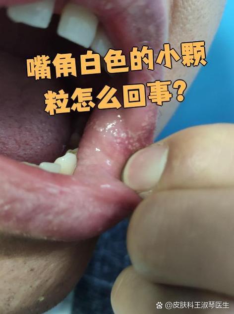 嘴角发白是怎么回事