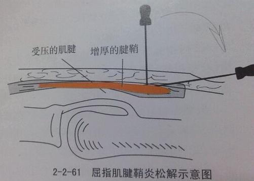 小针刀手术几天才能恢复好截图