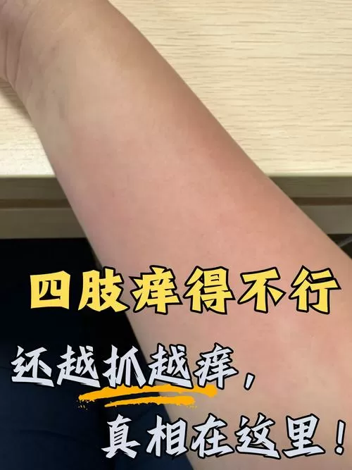 四肢痒越抓越痒