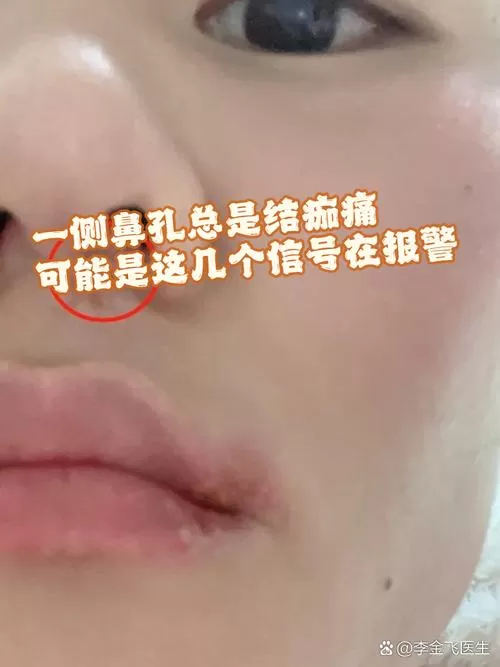 破鼻子太频繁预示着什么病截图