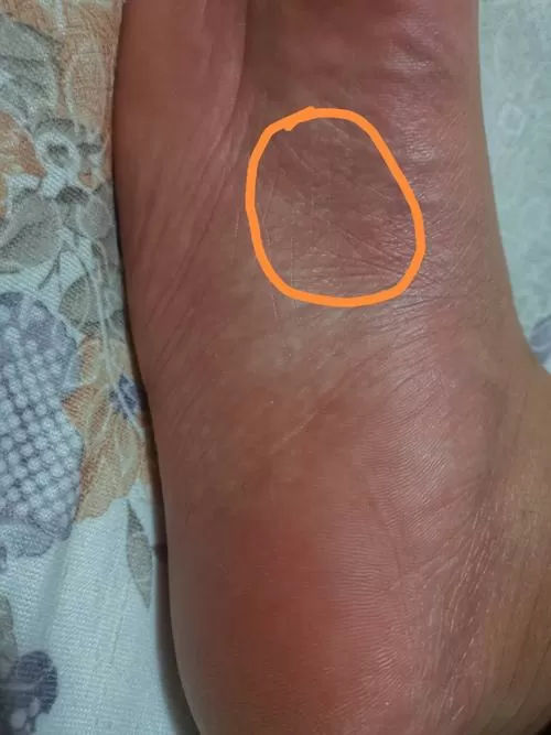 晚上睡觉时脚底板发痒