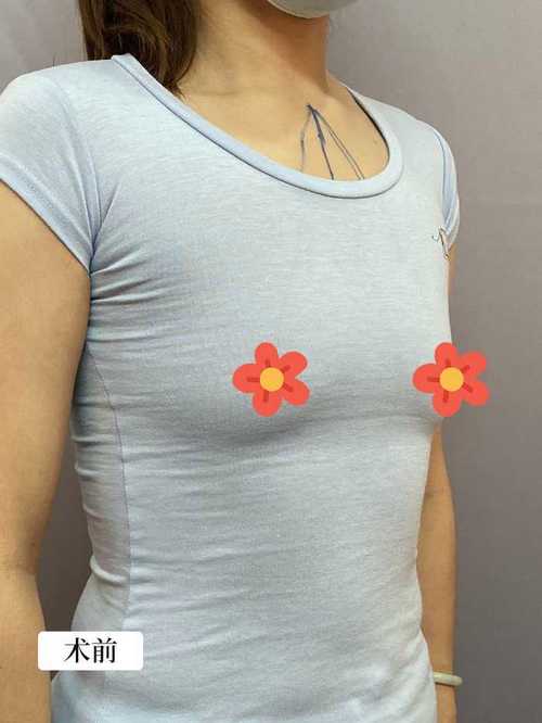 女子隆胸后假体塌陷