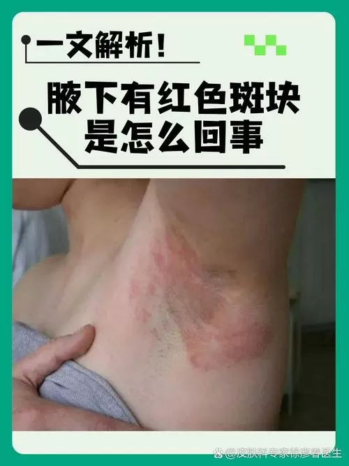 腋下很痒起了一片红疹