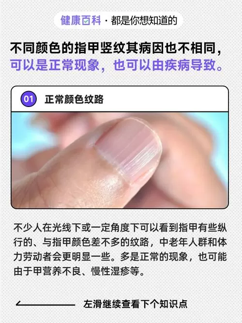 甲面有竖条纹什么原因