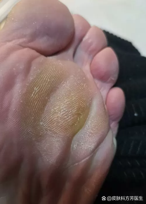 脚底板起茧子里面痒截图