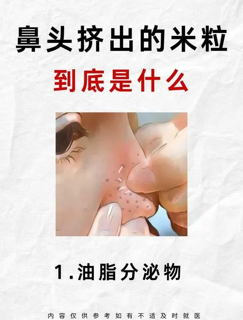 米粒进鼻子里但是出不来怎么办