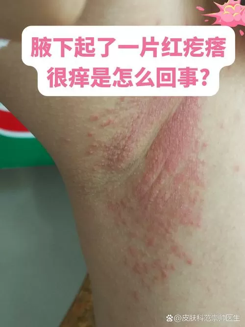 腋下很痒挠了以后都是小红疙瘩