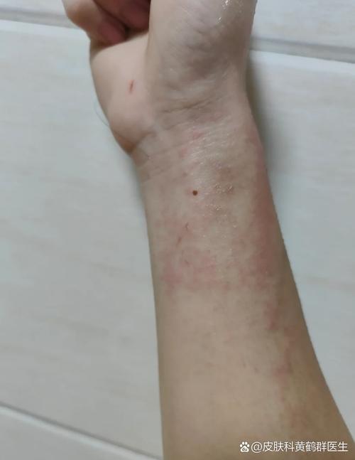 胳膊刺挠一挠就起疙瘩截图