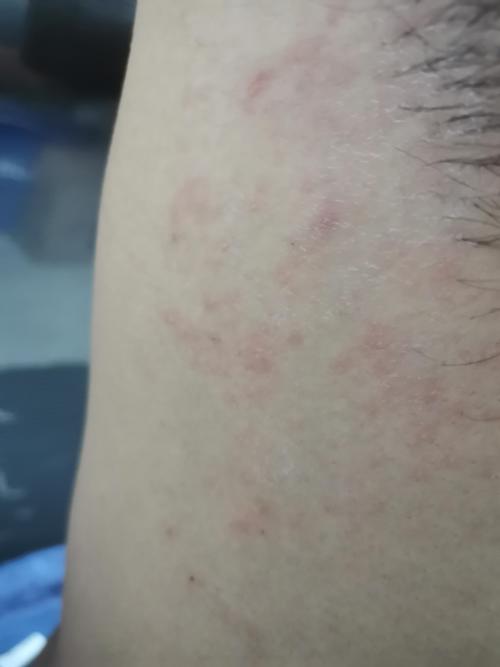 腋下长了疹子,越抓越痒,越来越多
